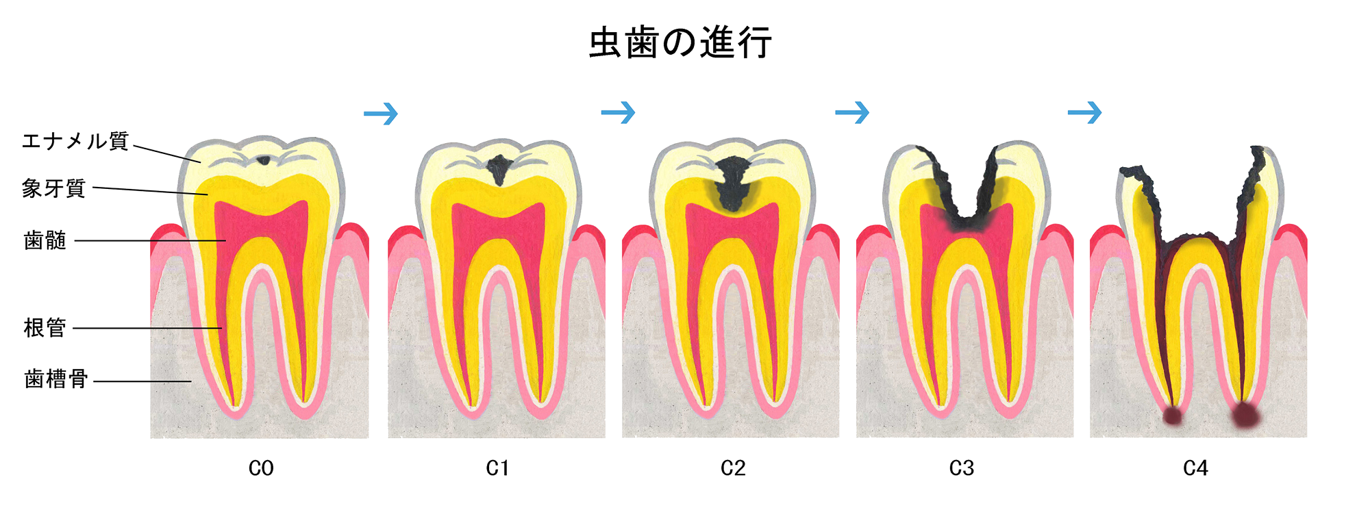 虫歯の進行度