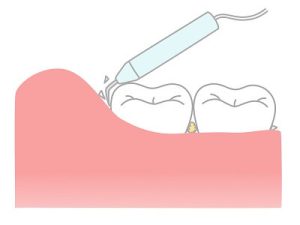 歯のクリーニング