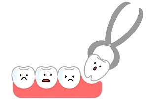 乳歯の抜歯
