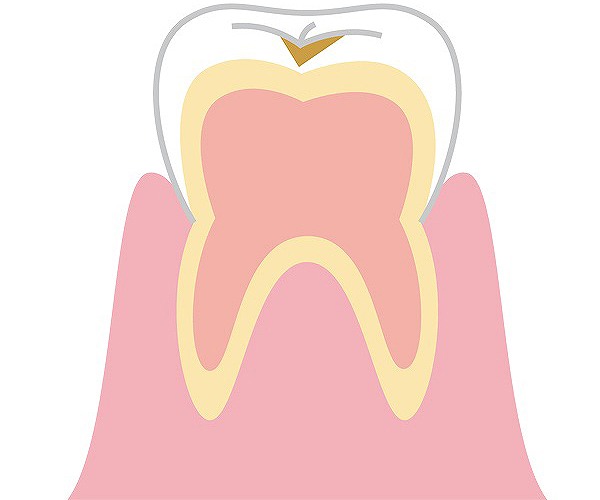 初期の虫歯は痛くない？放置するとどうなるのか