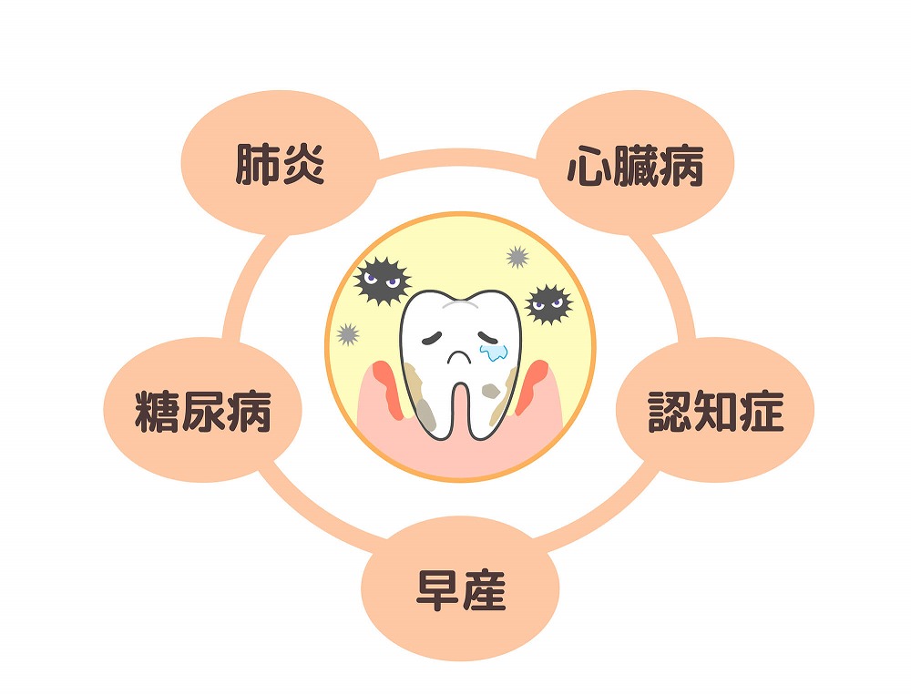歯周病は全身の様々な病気と関わりがある？