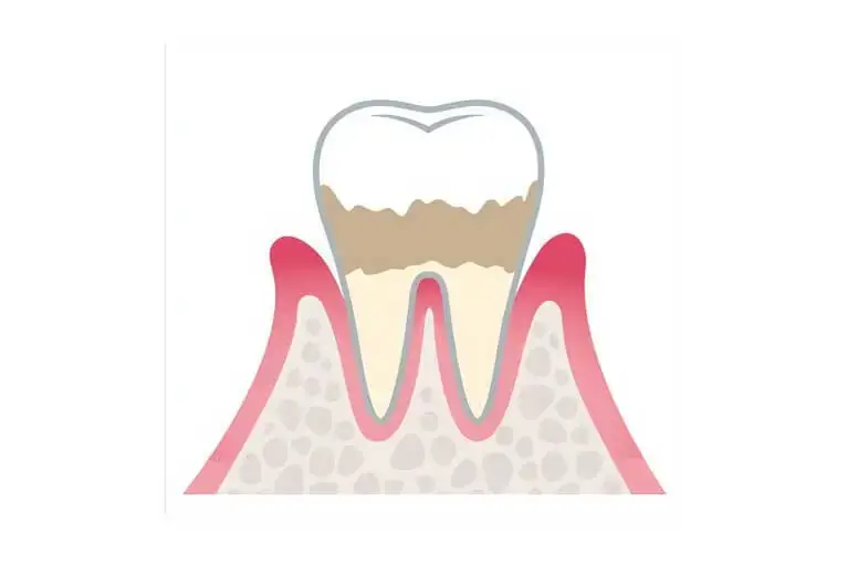 歯肉炎～軽度歯周病