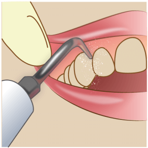セルフケアでは除去できない「歯石取り」