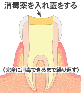 根管内をきれいに掃除、消毒する