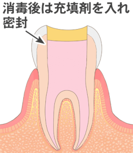 薬剤を充填させる