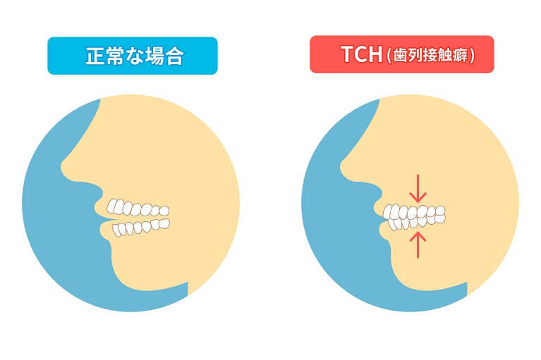 顎が痛い…顎関節症とは