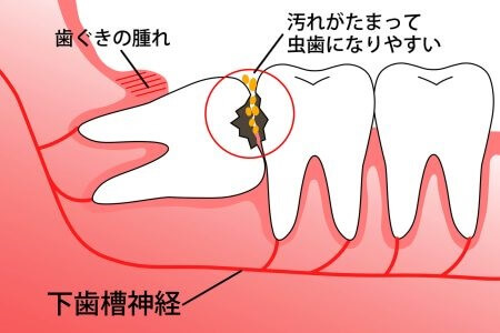 親知らずは抜歯しないといけないの？